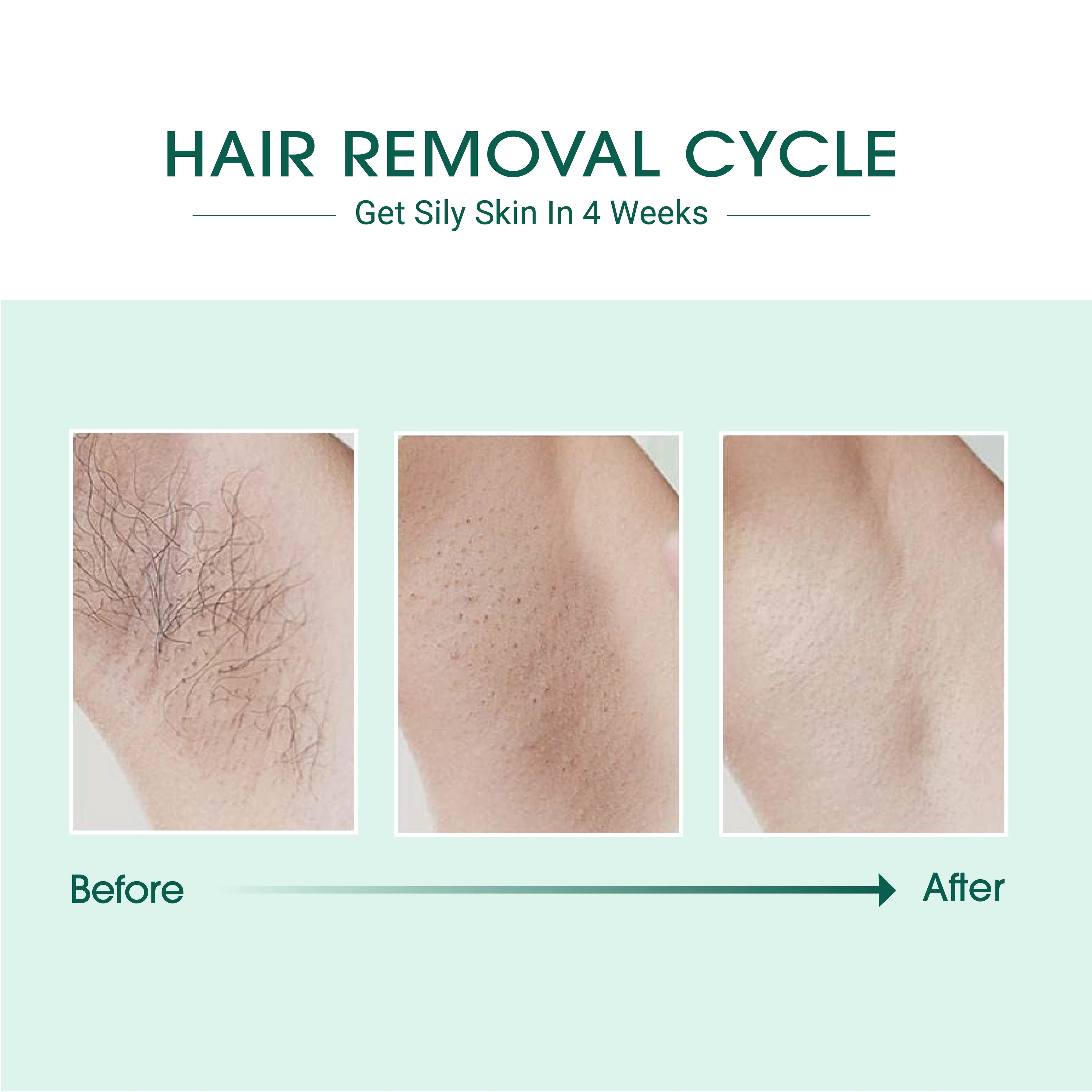 Épilation Laser IPL BeNat